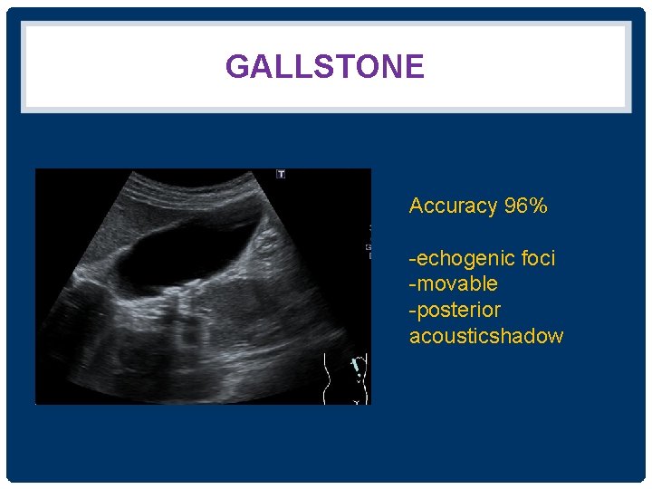 GALLSTONE Accuracy 96% -echogenic foci -movable -posterior acousticshadow 