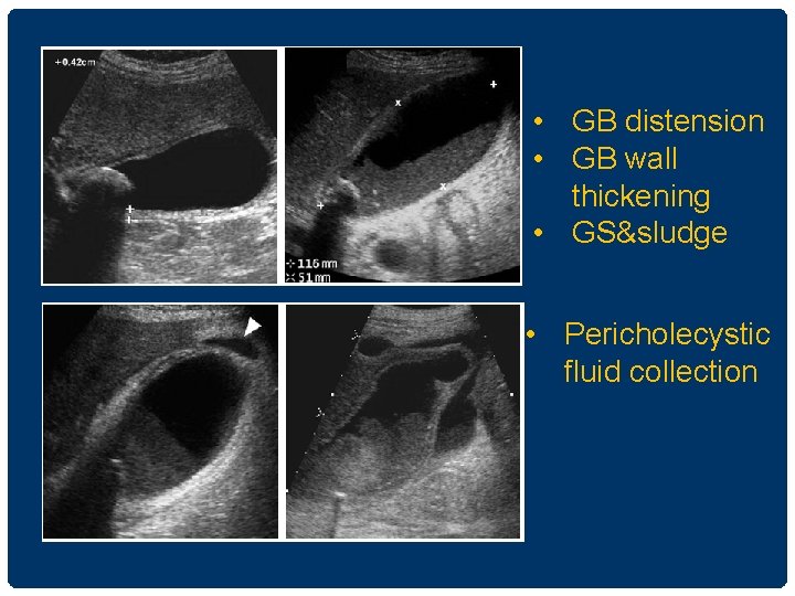  • GB distension • GB wall thickening • GS&sludge • Pericholecystic fluid collection