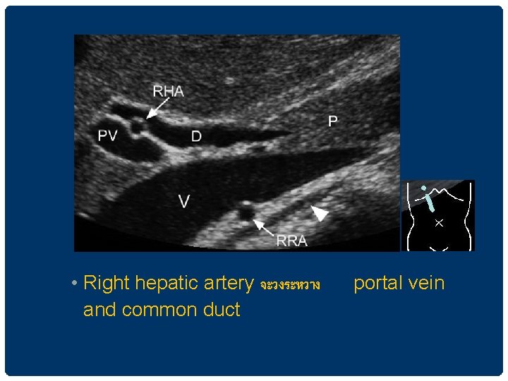  • Right hepatic artery จะวงระหวาง and common duct portal vein 