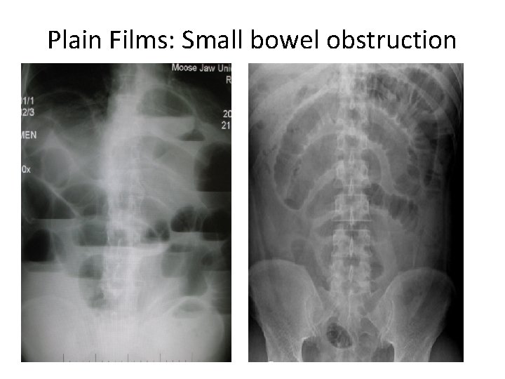 Plain Films: Small bowel obstruction 