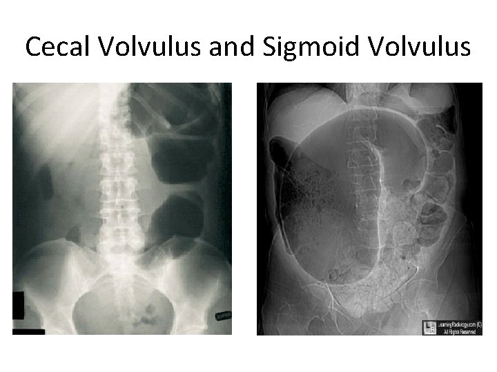 Cecal Volvulus and Sigmoid Volvulus 