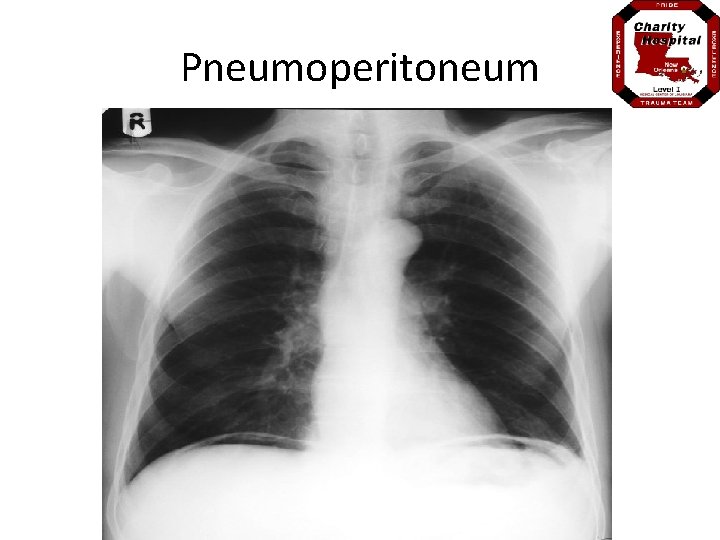 Pneumoperitoneum 