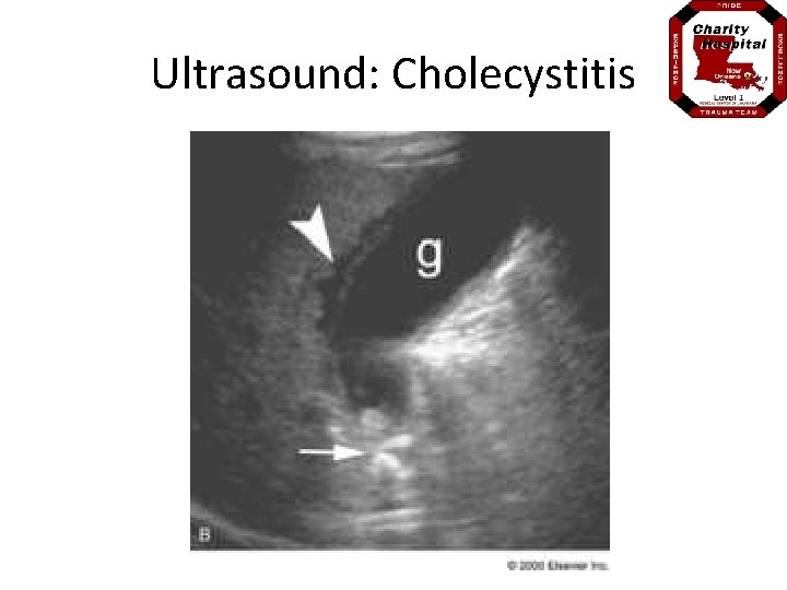 Ultrasound: Cholecystitis 