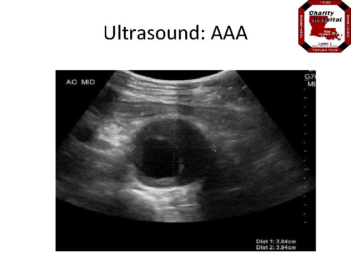 Ultrasound: AAA 