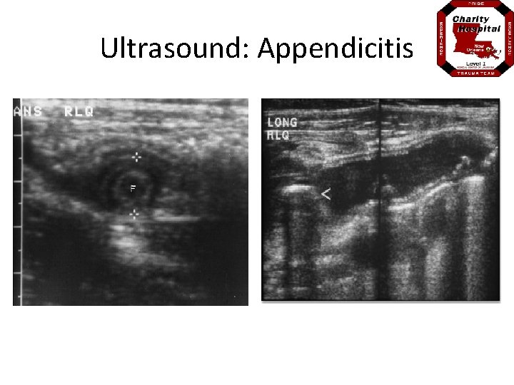 Ultrasound: Appendicitis 