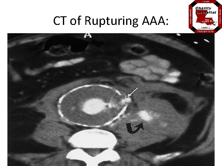 CT of Rupturing AAA: 