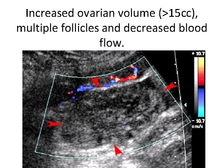 Increased ovarian volume (>15 cc), multiple follicles and decreased blood flow. 