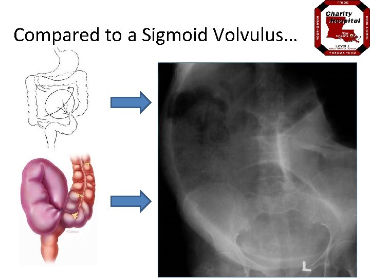 Compared to a Sigmoid Volvulus… 