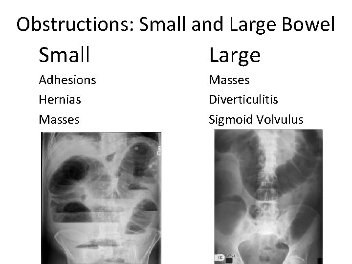 Obstructions: Small and Large Bowel Small Large Adhesions Hernias Masses Diverticulitis Sigmoid Volvulus 