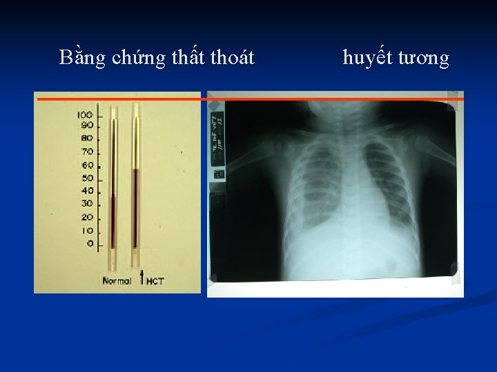 Bằng chứng thất thoát huyết tương 