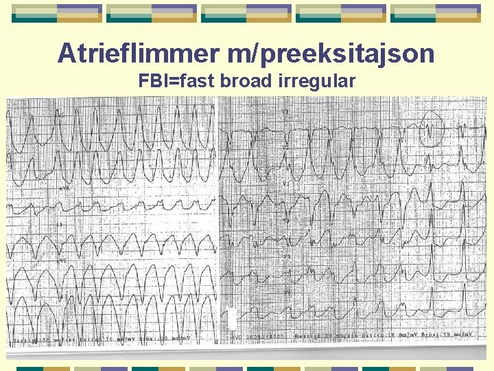 Atrieflimmer m/preeksitajson FBI=fast broad irregular 