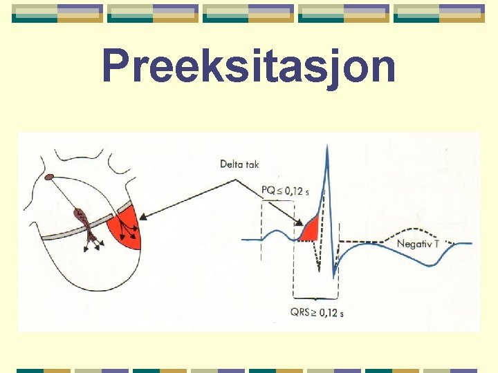 Preeksitasjon 