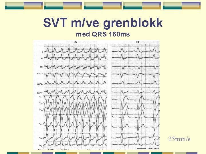 SVT m/ve grenblokk med QRS 160 ms 25 mm/s 