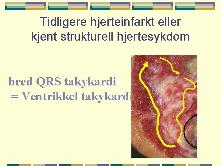 Tidligere hjerteinfarkt eller kjent strukturell hjertesykdom bred QRS takykardi = Ventrikkel takykardi 