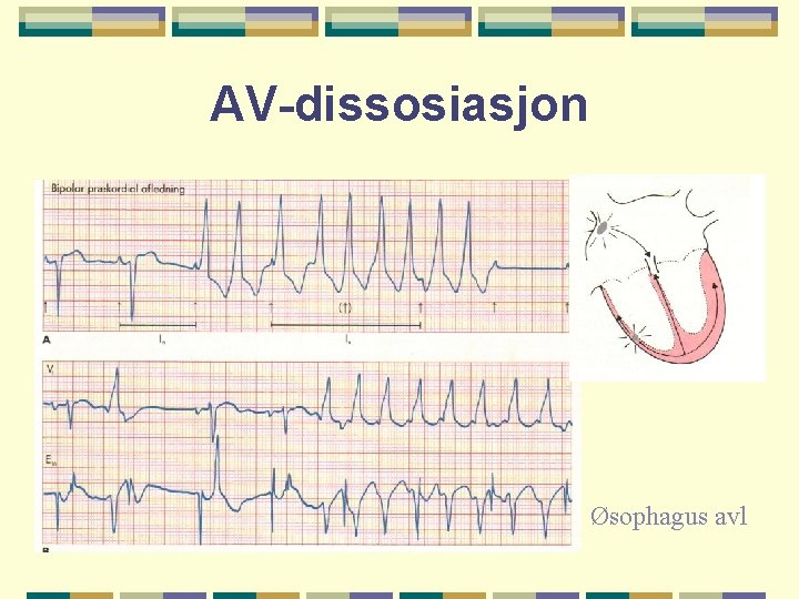 AV-dissosiasjon Øsophagus avl 