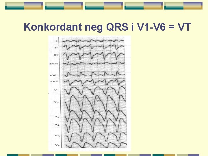 Konkordant neg QRS i V 1 -V 6 = VT 