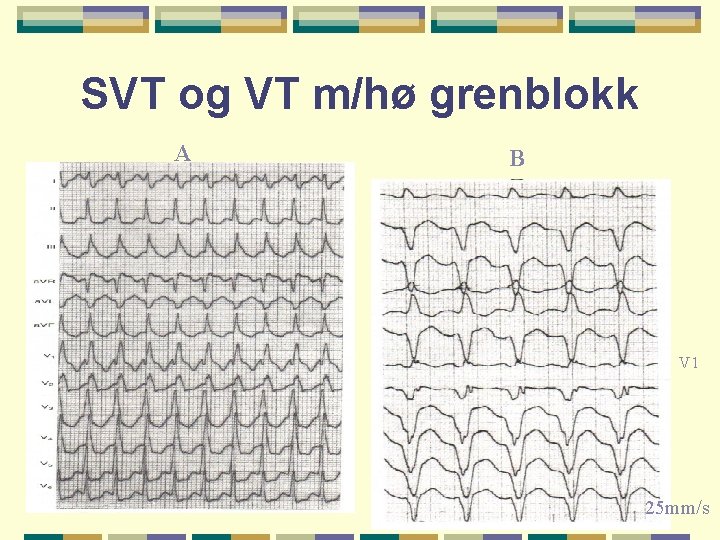 SVT og VT m/hø grenblokk A B V 1 25 mm/s 