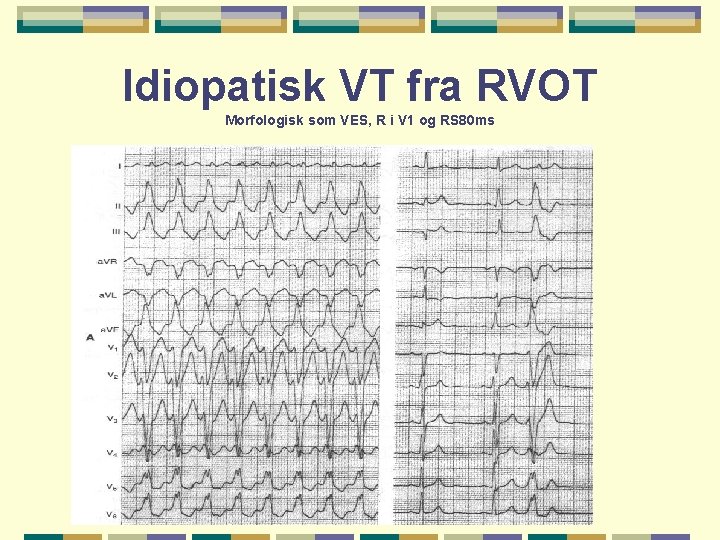 Idiopatisk VT fra RVOT Morfologisk som VES, R i V 1 og RS 80