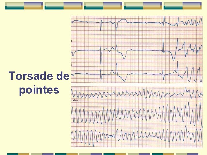 Torsade de pointes 