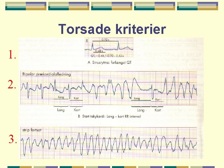 Torsade kriterier 1. 2. 3. 