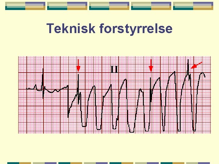 Teknisk forstyrrelse 