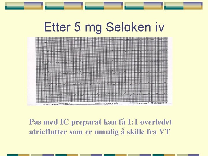 Etter 5 mg Seloken iv Pas med IC preparat kan få 1: 1 overledet