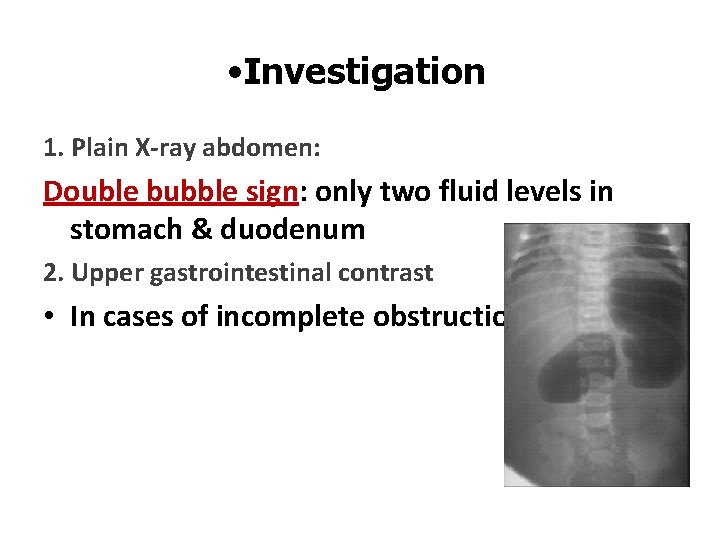  • Investigation 1. Plain X-ray abdomen: Double bubble sign: only two fluid levels