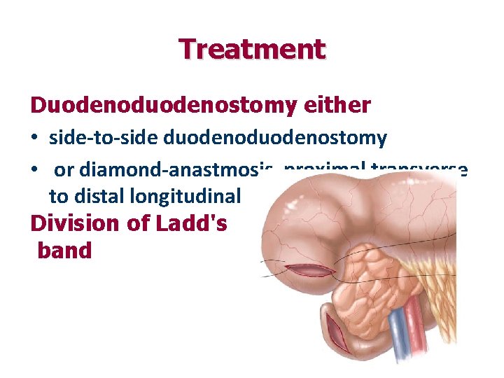 Treatment Duodenoduodenostomy either • side-to-side duodenostomy • or diamond-anastmosis proximal transverse to distal longitudinal