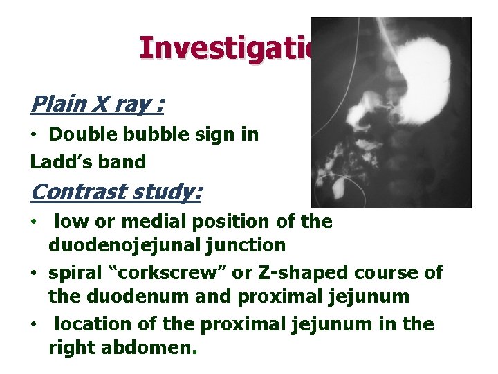 Investigations Plain X ray : • Double bubble sign in Ladd’s band Contrast study: