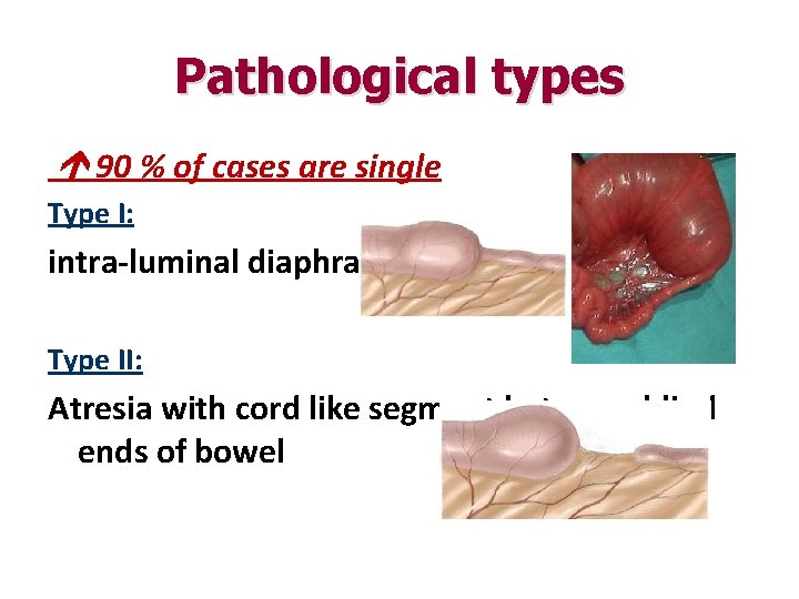 Pathological types 90 % of cases are single Type I: intra-luminal diaphragm Type II: