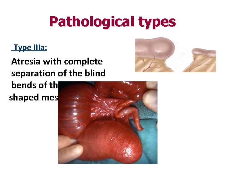 Pathological types Type IIIa: Atresia with complete separation of the blind bends of the