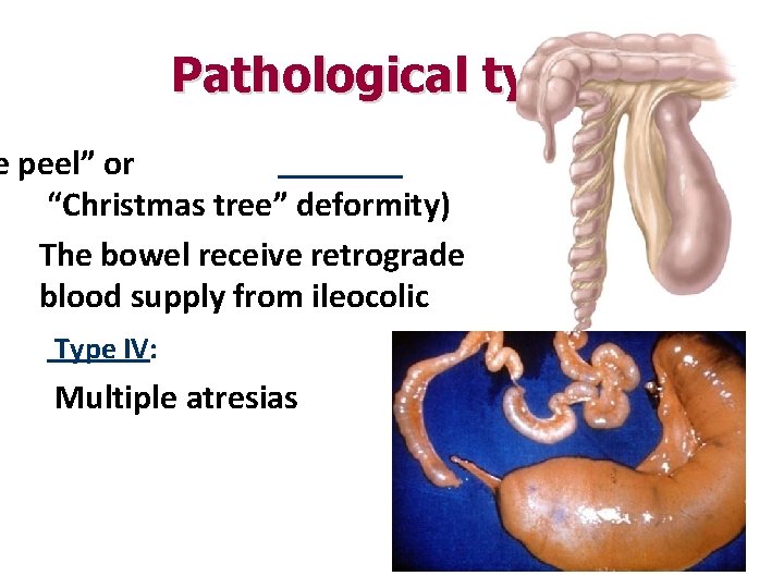 Pathological types e peel” or “Christmas tree” deformity) The bowel receive retrograde blood supply