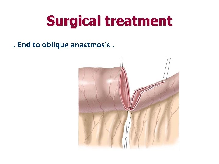 Surgical treatment. End to oblique anastmosis. 