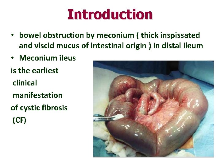 Introduction • bowel obstruction by meconium ( thick inspissated and viscid mucus of intestinal