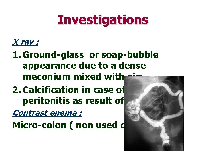 Investigations X ray : 1. Ground-glass or soap-bubble appearance due to a dense meconium