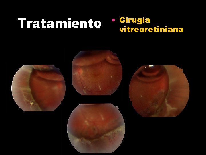 Tratamiento • Cirugía vitreoretiniana 