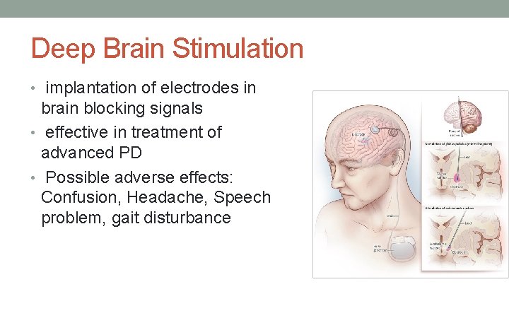 Deep Brain Stimulation • implantation of electrodes in brain blocking signals • effective in