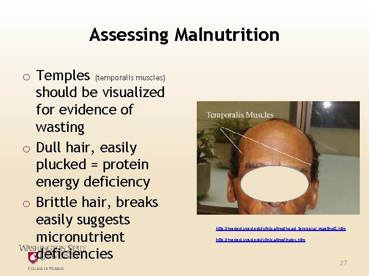 Assessing Malnutrition o Temples (temporalis muscles) should be visualized for evidence of wasting o