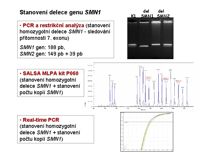 Stanovení delece genu SMN 1 • PCR a restrikční analýza (stanovení homozygotní delece SMN