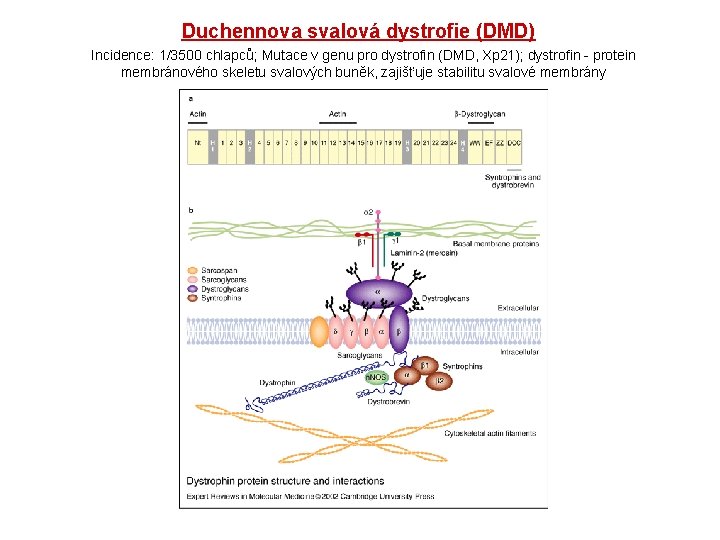 Duchennova svalová dystrofie (DMD) Incidence: 1/3500 chlapců; Mutace v genu pro dystrofin (DMD, Xp