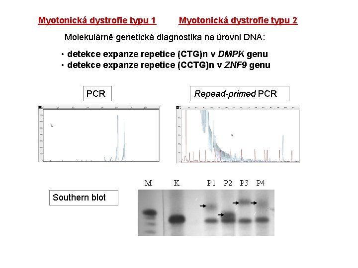 Myotonická dystrofie typu 1 Myotonická dystrofie typu 2 Molekulárně genetická diagnostika na úrovni DNA: