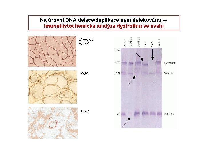 Na úrovni DNA delece/duplikace není detekována → imunohistochemická analýza dystrofinu ve svalu Normální vzorek