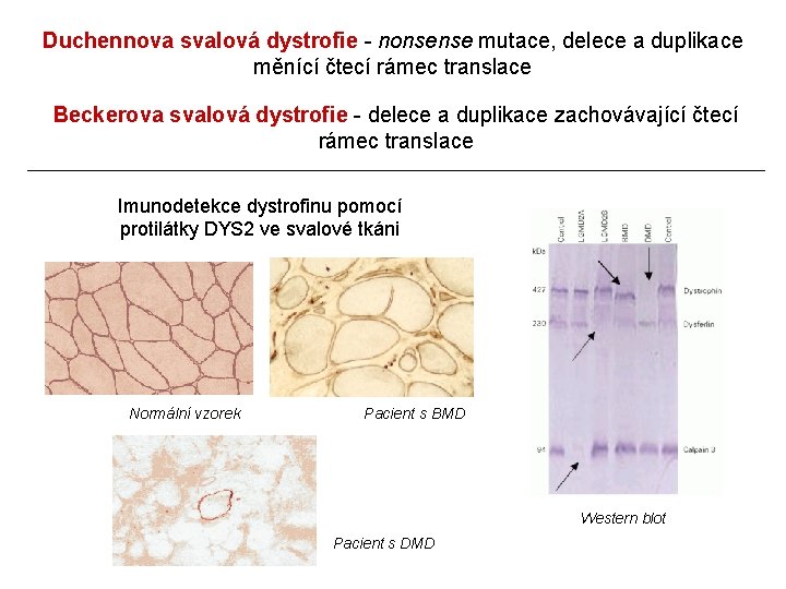 Duchennova svalová dystrofie - nonsense mutace, delece a duplikace měnící čtecí rámec translace Beckerova