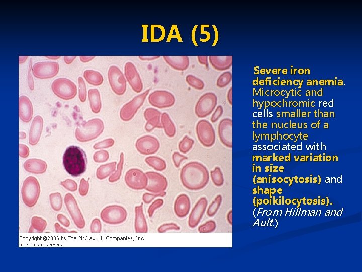 IDA (5) Severe iron deficiency anemia. Microcytic and hypochromic red cells smaller than the