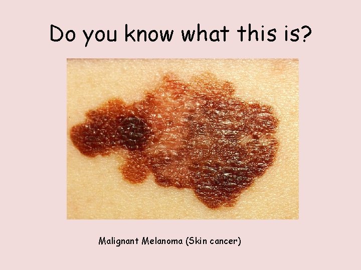 Do you know what this is? Malignant Melanoma (Skin cancer) 