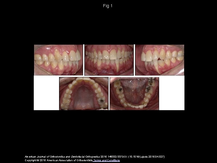 Fig 1 American Journal of Orthodontics and Dentofacial Orthopedics 2015 148332 -337 DOI: (10.
