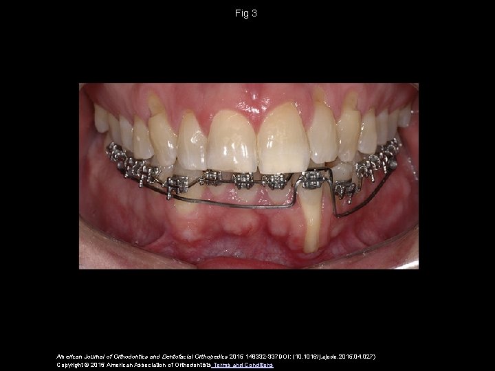Fig 3 American Journal of Orthodontics and Dentofacial Orthopedics 2015 148332 -337 DOI: (10.