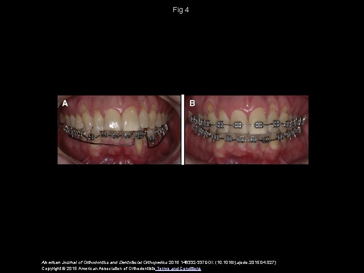 Fig 4 American Journal of Orthodontics and Dentofacial Orthopedics 2015 148332 -337 DOI: (10.