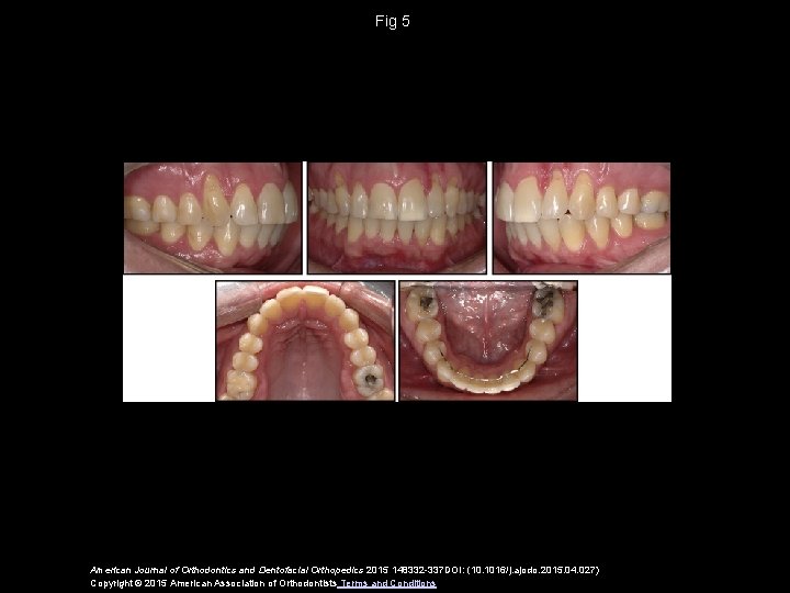 Fig 5 American Journal of Orthodontics and Dentofacial Orthopedics 2015 148332 -337 DOI: (10.