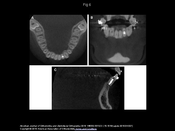 Fig 6 American Journal of Orthodontics and Dentofacial Orthopedics 2015 148332 -337 DOI: (10.